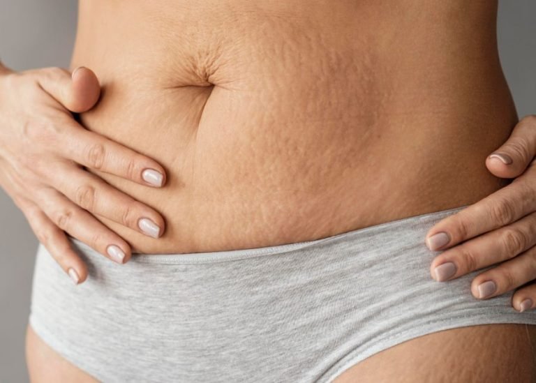 10 Cara Menghilangkan Stretch Mark, Manfaatkan Bahan Alami!