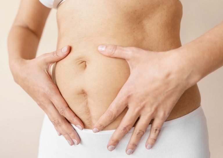 7 Cara Menghilangkan Stretch Mark Setelah Melahirkan, Simak!